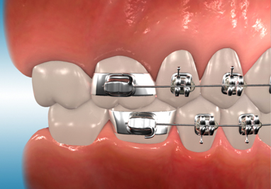 Types of Braces (Fixed Appliances)