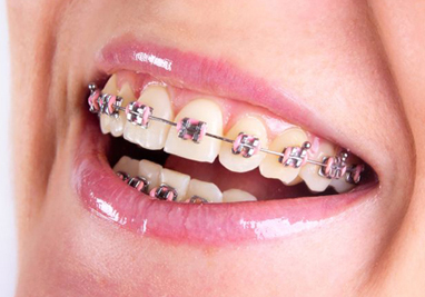 braces